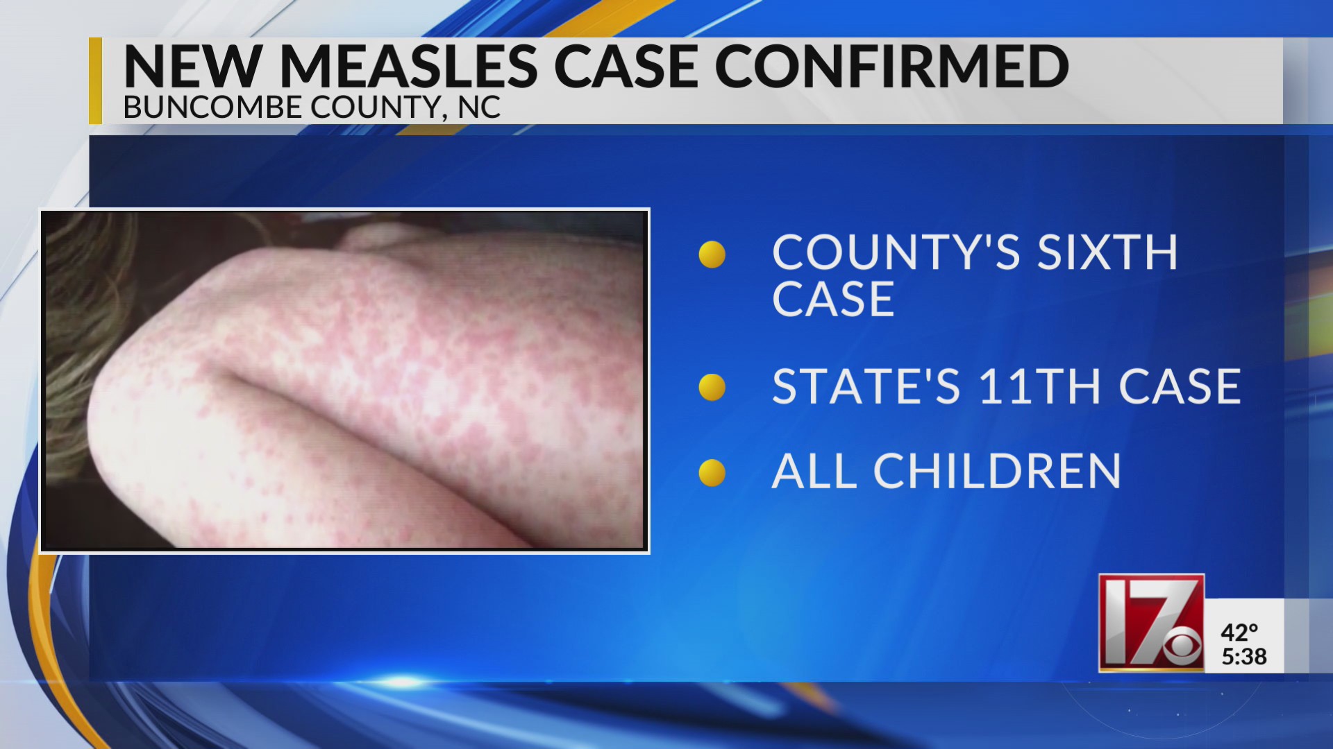 Maine Confirms Sixth Measles Case, Warns of Waterville Exposure