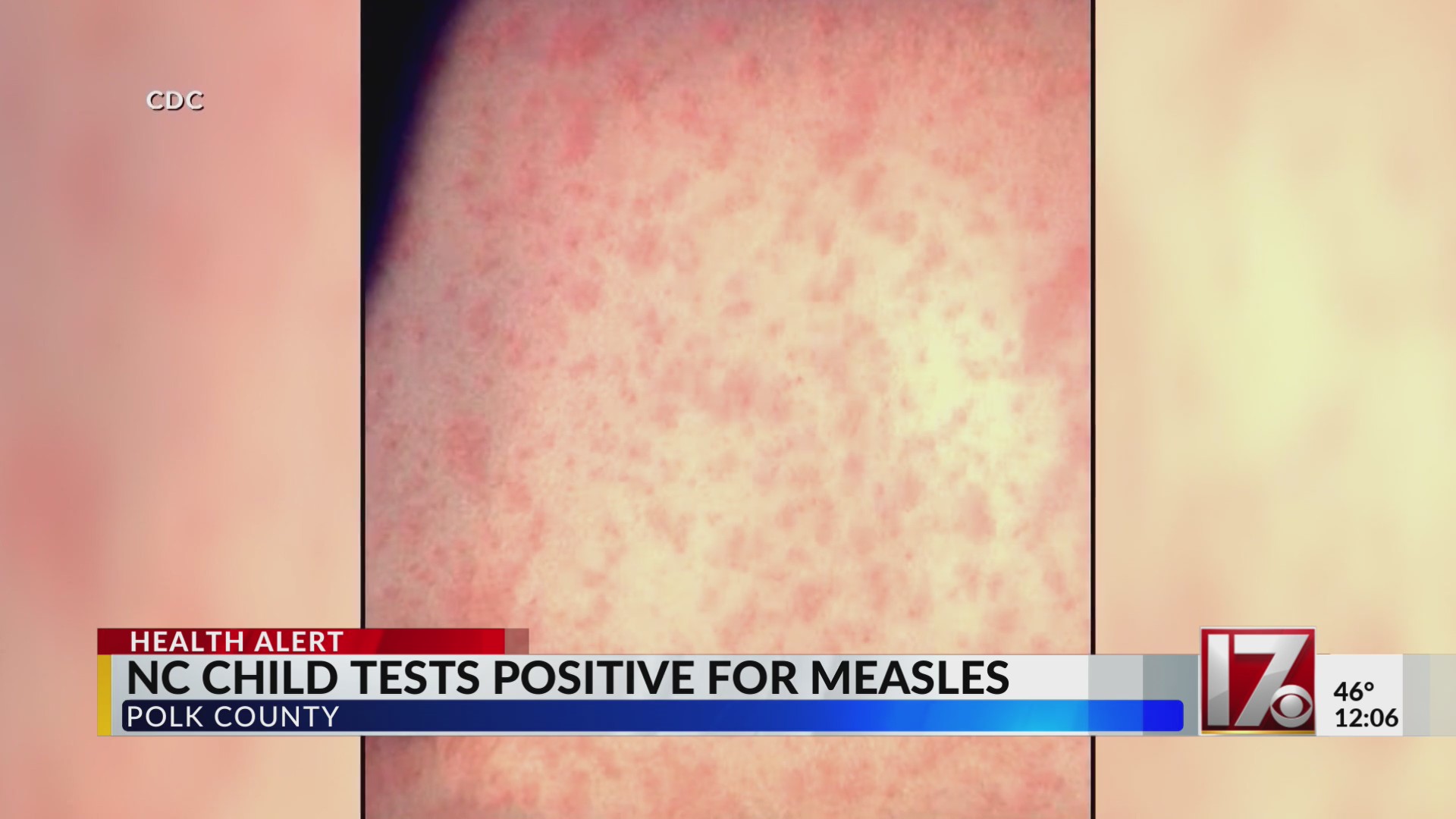 North Carolina child tests positive for measles – CBS17.com