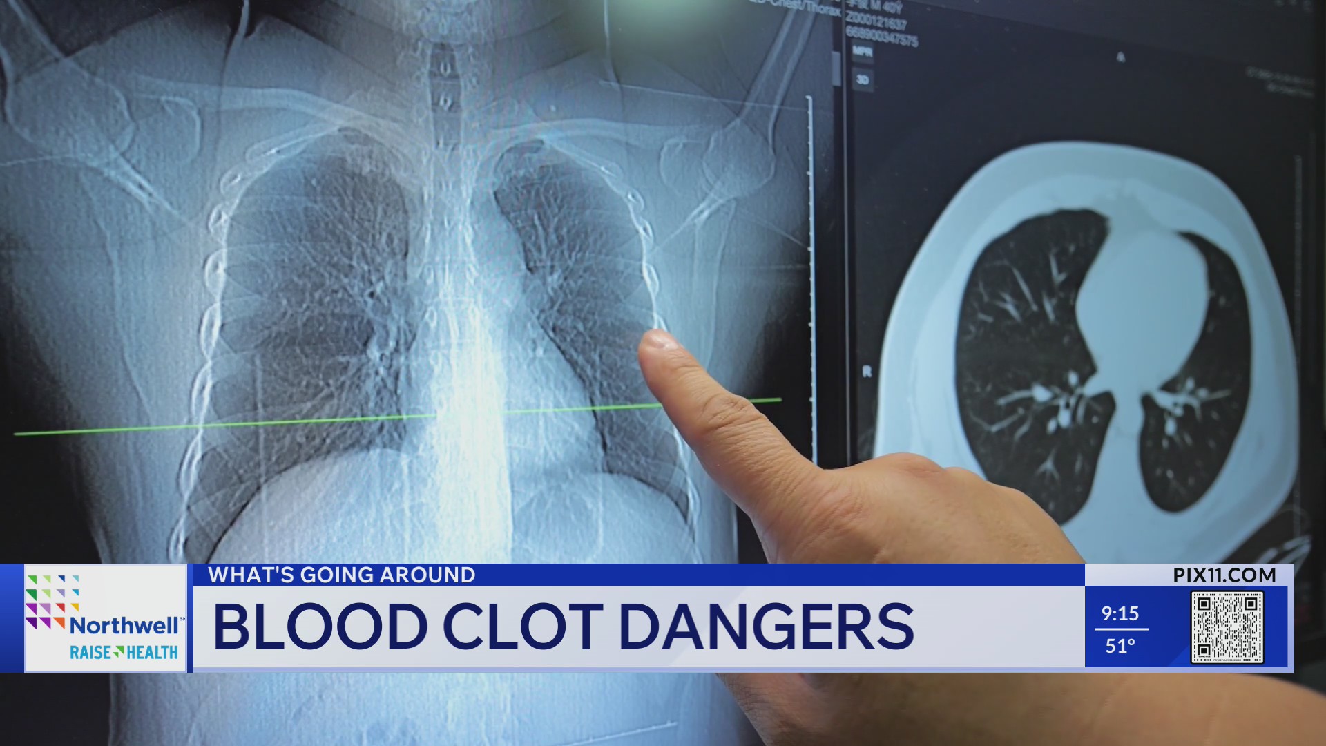 ‘What’s Going Around’: Blood clot dangers – PIX11