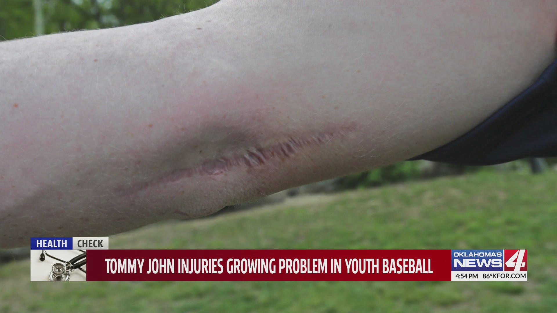 Sun Lin Injurys Tommy John injuries growing problem in youth baseball – KXAN Austin