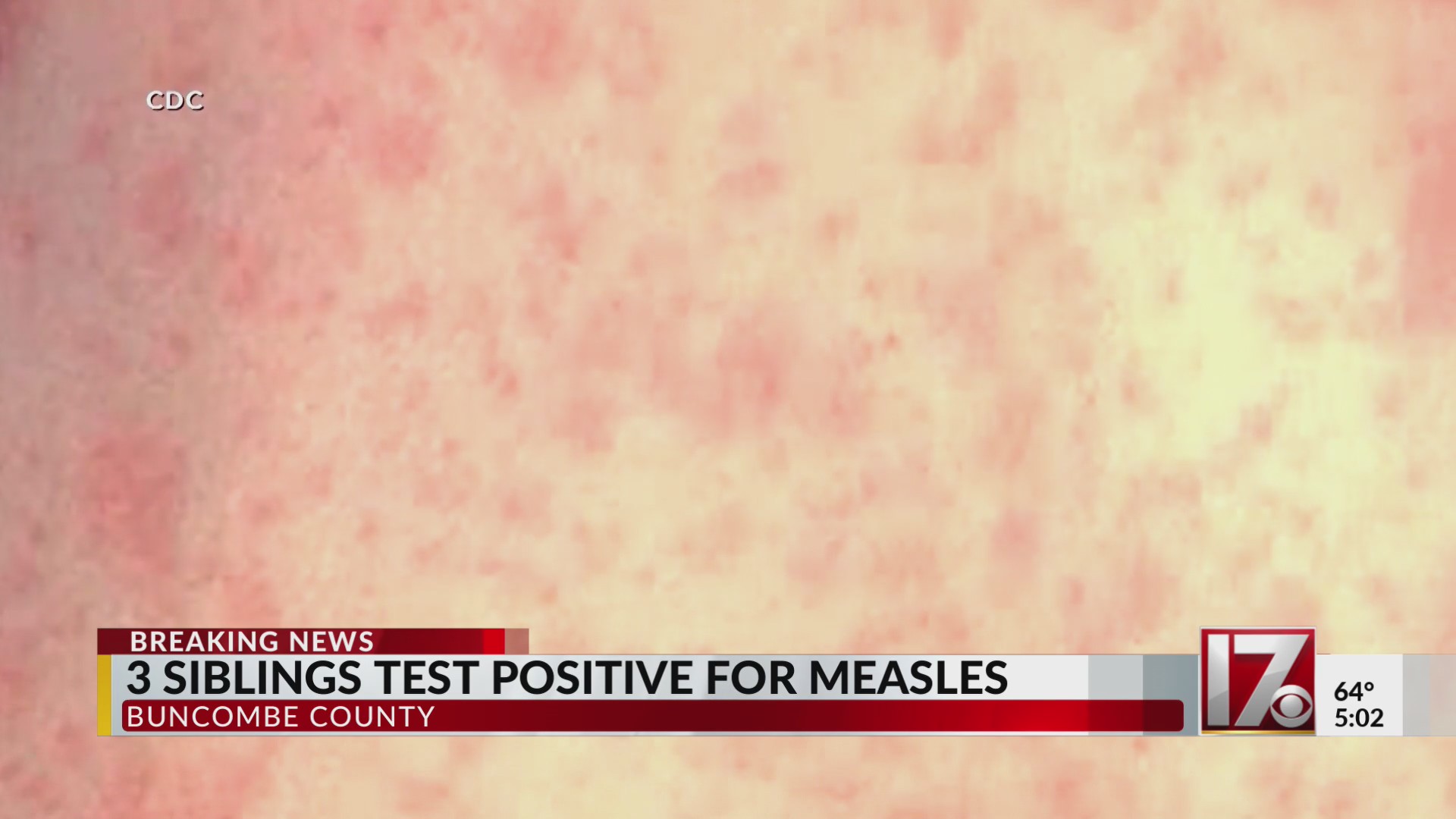 Three siblings test positive for measles in North Carolina – CBS17.com